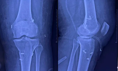 “Hồi sinh” khớp gối đứt 3 dây chằng sau tai nạn giao thông